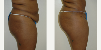 Case 2732 - 25-34 year old woman treated with Tummy Tuck