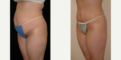 Case 2733 - 25-34 year old woman treated with Tummy Tuck