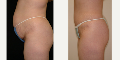 Case 2734 - 25-34 year old woman treated with Tummy Tuck