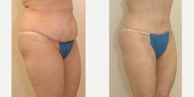 Case 2735 - 35-44 year old woman treated with Tummy Tuck