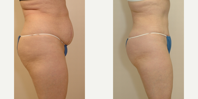 Case 2736 - 35-44 year old woman treated with Tummy Tuck