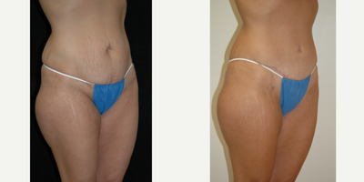 Case 2737 - 25-34 year old woman treated with Tummy Tuck