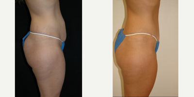 Case 2738 - 25-34 year old woman treated with Tummy Tuck