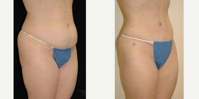 Case 2739 - 35-44 year old woman treated with Tummy Tuck