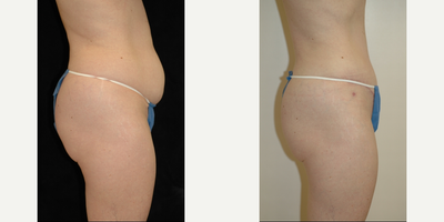 Case 2740 - 35-44 year old woman treated with Tummy Tuck