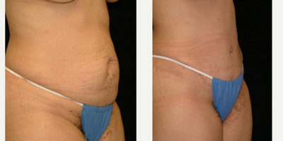 Case 2741 - 25-34 year old woman treated with Tummy Tuck
