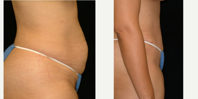 Case 2742 - 25-34 year old woman treated with Tummy Tuck