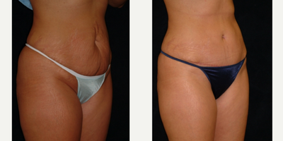 Case 2743 - 25-34 year old woman treated with Tummy Tuck