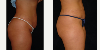 Case 2744 - 25-34 year old woman treated with Tummy Tuck