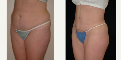 Case 2745 - 25-34 year old woman treated with Tummy Tuck