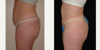 Case 2746 - 25-34 year old woman treated with Tummy Tuck