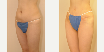 Case 2747 - 35-44 year old woman treated with Tummy Tuck