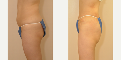 Case 2748 - 35-44 year old woman treated with Tummy Tuck