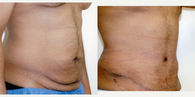 Case 2749 - 25-34 year old man treated with Tummy Tuck