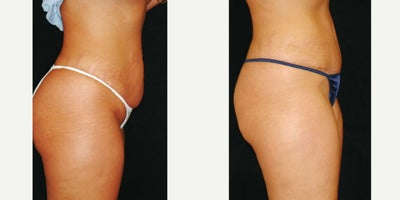 Case 2750 - 25-34 year old woman treated with Tummy Tuck