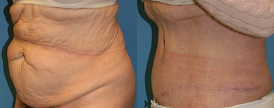 Case 2751 - Woman treated with Tummy Tuck