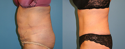 Case 2752 - Woman treated with Tummy Tuck