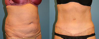 Case 2753 - Woman treated with Tummy Tuck
