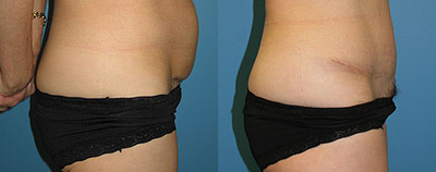 Case 2754 - Woman treated with Tummy Tuck