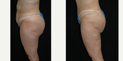 Case 2755 - 25-34 year old woman treated with Tummy Tuck