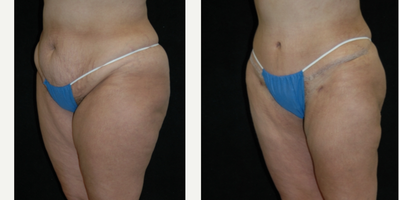 Case 2756 - 25-34 year old woman treated with Tummy Tuck