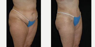 Case 2757 - 25-34 year old woman treated with Tummy Tuck