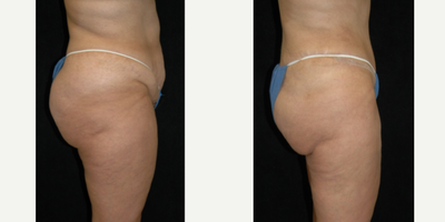 Case 2758 - 25-34 year old woman treated with Tummy Tuck