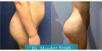 Case 2759 - Woman treated with Tummy Tuck