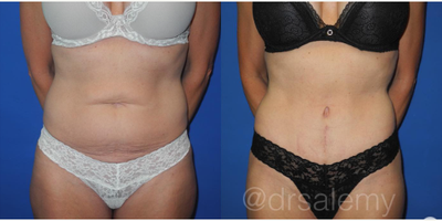 Case 276 - Woman treated with Tummy Tuck