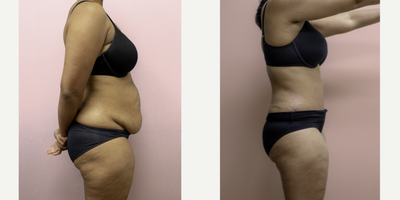 Case 2762 - 35-44 year old woman treated with Tummy Tuck