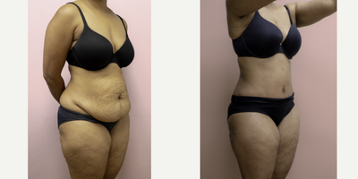 Case 2763 - 35-44 year old woman treated with Tummy Tuck