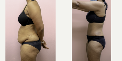 Case 2764 - 35-44 year old woman treated with Tummy Tuck