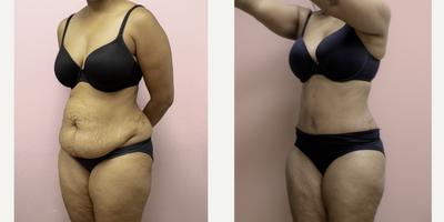 Case 2765 - 35-44 year old woman treated with Tummy Tuck