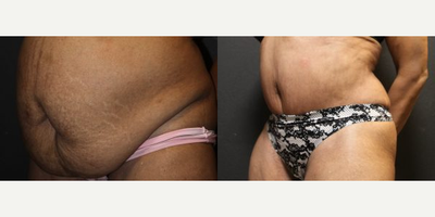 Case 2766 - Woman treated with Tummy Tuck