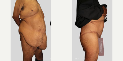 Case 2768 - 55-64 year old man treated with Body Lift