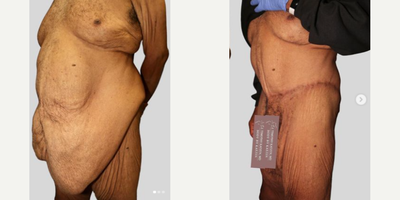 Case 2769 - 55-64 year old man treated with Body Lift