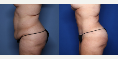 Case 2770 - 45-54 year old woman treated with Tummy Tuck