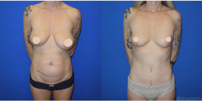Case 278 - Woman treated with Tummy Tuck