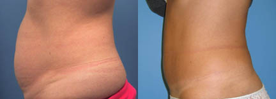 Case 2782 - Woman treated with Tummy Tuck