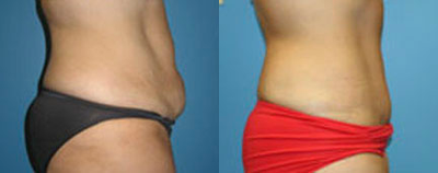 Case 2783 - Woman treated with Tummy Tuck