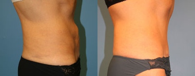 Case 2784 - 65 year old woman treated with Tummy Tuck