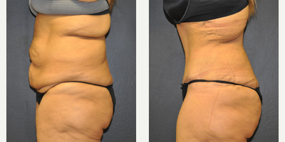 Case 2785 - Woman treated with Tummy Tuck