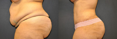 Case 2786 - 30 year old woman treated with Tummy Tuck