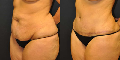 Case 2787 - 40 year old woman treated with Tummy Tuck