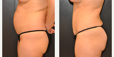 Case 2788 - 36 year old woman treated with Tummy Tuck