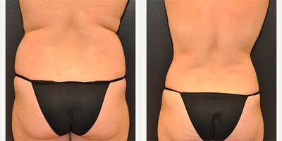 Case 2789 - 36 year old woman treated with Tummy Tuck
