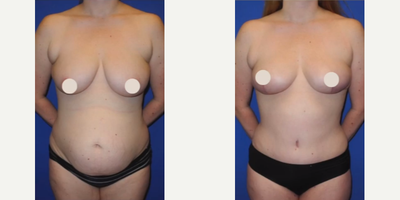Case 279 - Woman treated with Tummy Tuck