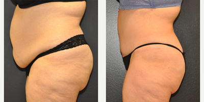 Case 2790 - 52 year old woman treated with Tummy Tuck