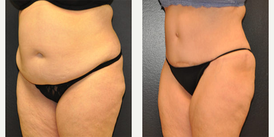 Case 2791 - 52 year old woman treated with Tummy Tuck
