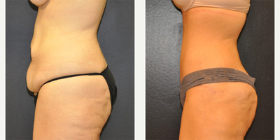 Case 2792 - 32 year old woman treated with Tummy Tuck